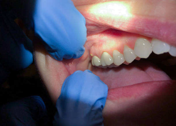 Best Emergency Root Canal Treatment in Ferrum, VA